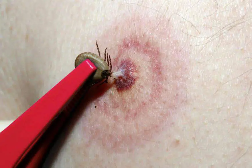 como eliminar la garrapata